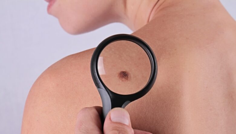vaccino melanoma
